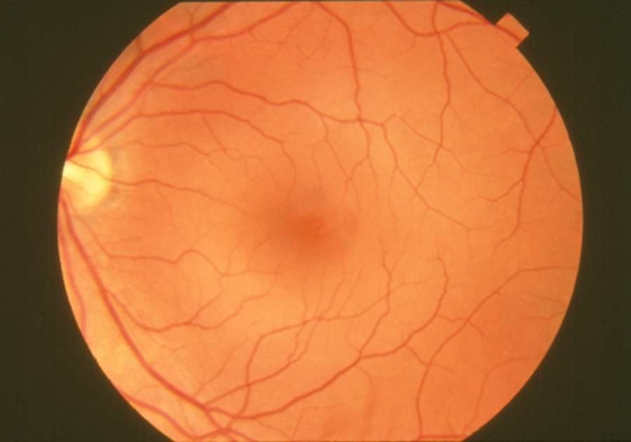 Colour fundus photograph of a healthy human retina