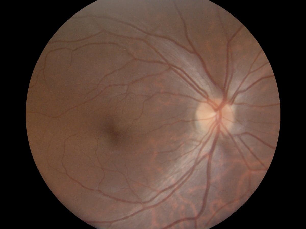 A colour retinal fundus photograph captured by the Airdoc AI screening system